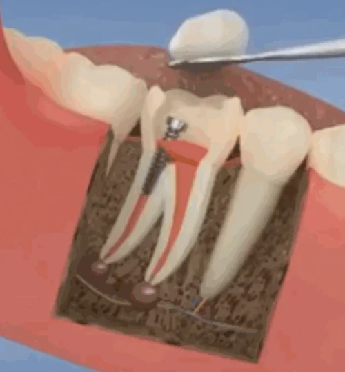 GIF animata che illustra i passaggi di una devitalizzazione dentale per spiegare una procedura nei corsi e-learning